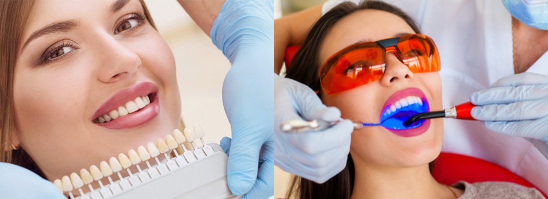 کامپوزیت دندان چگونه انجام می شود؟