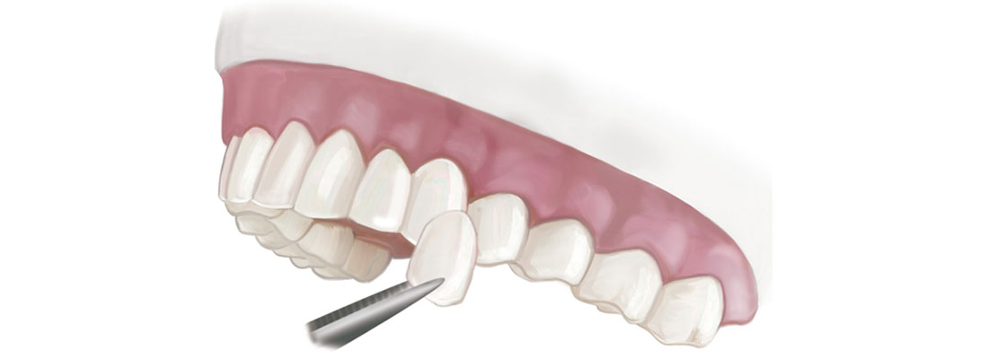 روکش دندان چیست و چه کاربردی دارد
