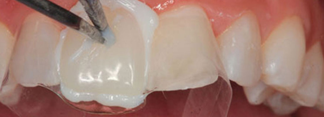 کامپوزیت دندان چیست و چه کاربردی دارد