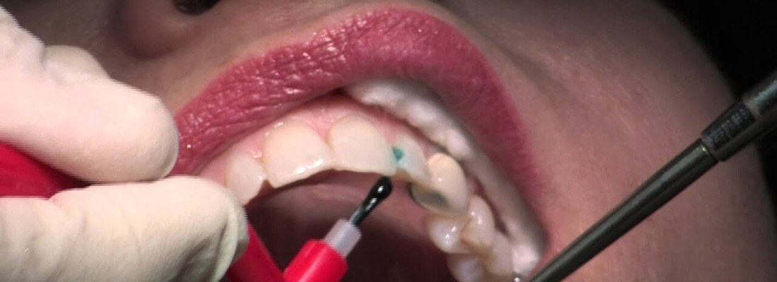 یکی از روش های ترمیم پر کردن دندان های جلو می باشد
